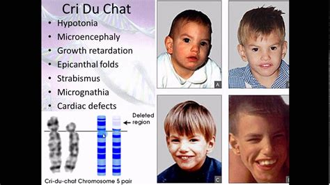 Exploring Highlander Syndrome: A Rare Genetic Disorder